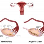 7 Tell Tale signs of PCOS You Should Know About
