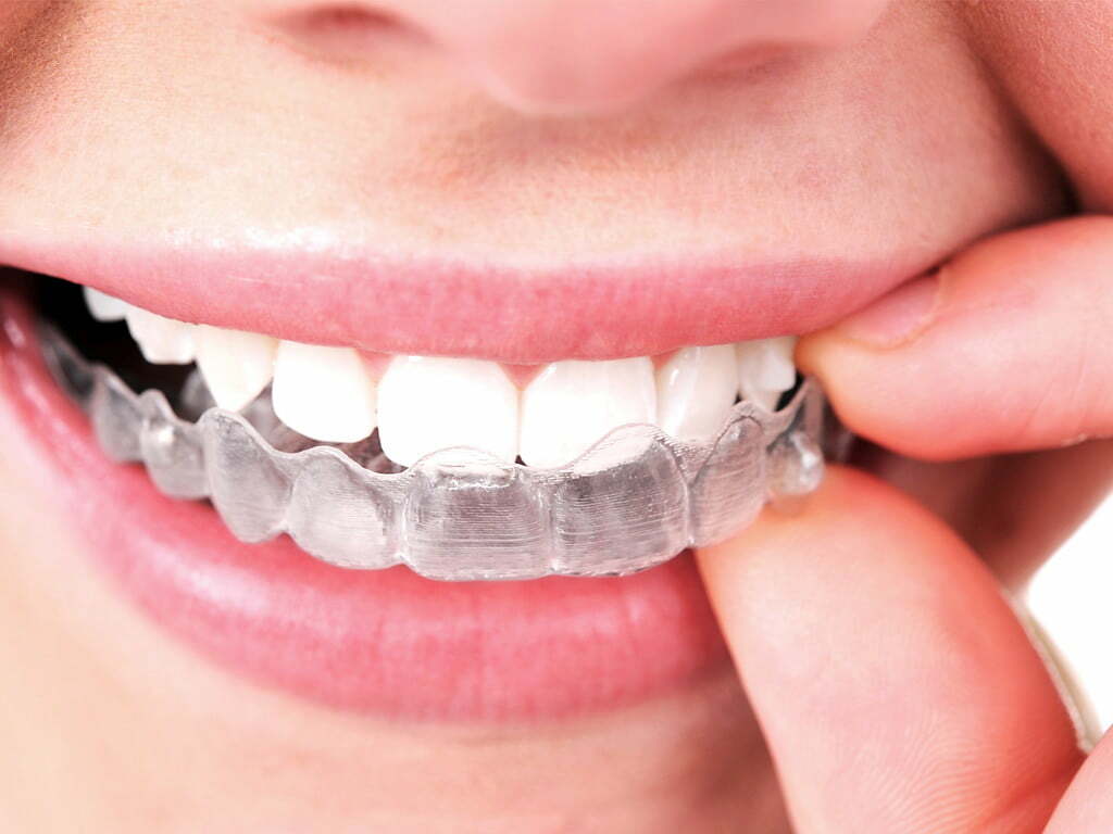 Maintaining Your Post-Invisible Aligner Smile
