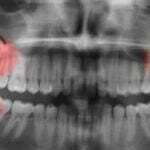 What to Expect Before Wisdom Teeth Extraction | Davisville Dentist Toronto