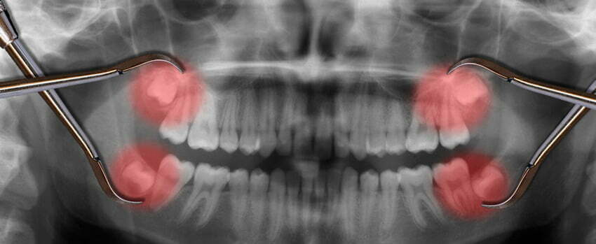 What to Expect Before Wisdom Teeth Extraction | Davisville Dentist Toronto