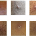 six images of monkeypox lesions on different skin tones.