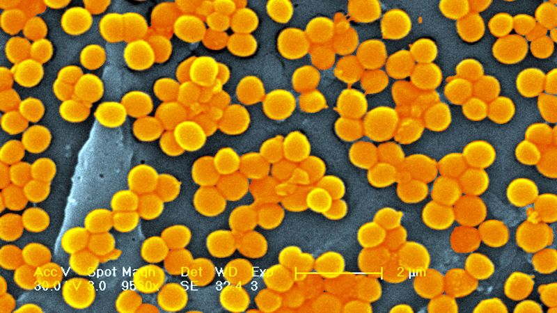 Nearly 40 million people could die from antibiotic-resistant superbug infections by 2050, new study estimates